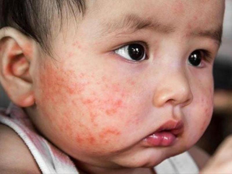 Chăm sóc trẻ bị chàm sữa