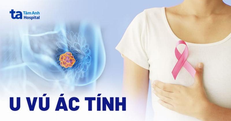 Hình ảnh minh họa các yếu tố cần cân nhắc khi chọn sữa tăng cân cho bé, bao gồm hộp sữa, biểu đồ tăng trưởng, ống tiêm (biểu tượng y tế), và hình em bé khỏe mạnh.