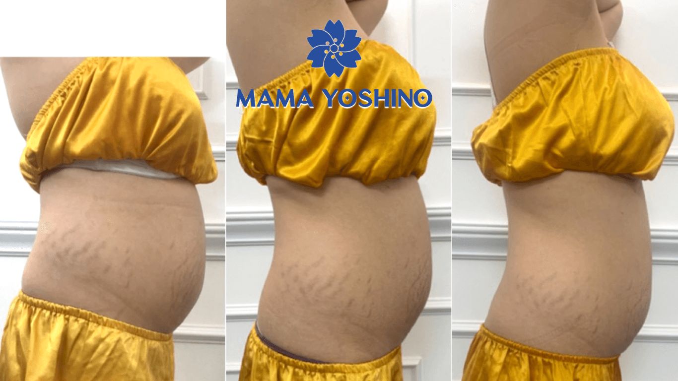 Liệu trình giảm béo bụng sau sinh tại Mama Yoshino