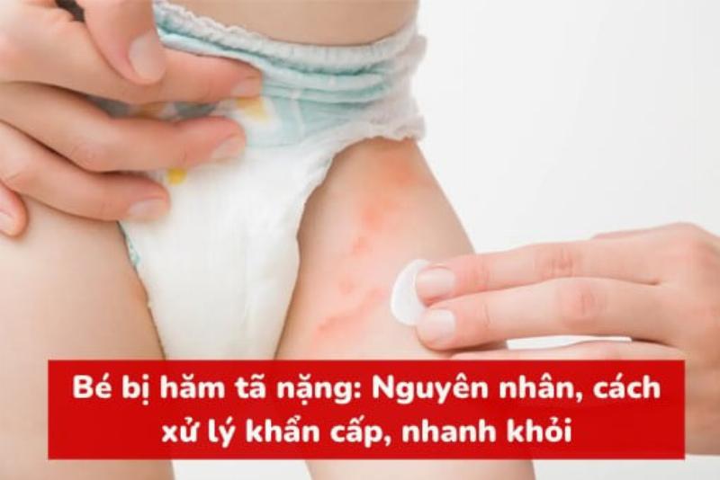 Hướng dẫn chăm sóc da cho trẻ sơ sinh khi mặc bỉm, bao gồm vệ sinh, thoa kem chống hăm, và để da bé thoáng khí, giúp ngăn ngừa hăm tã.
