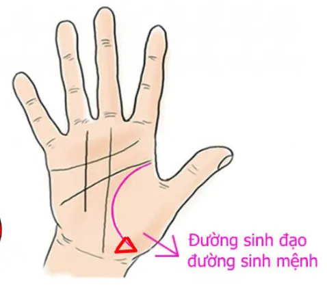 Dấu hiệu hình tam giác khép kín xuất hiện trên đường Sinh Đạo, cho thấy khả năng cần phẫu thuật hoặc tổn thương cơ thể