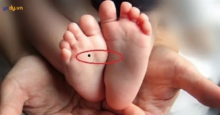 Có nên xóa nốt ruồi ở bàn chân không