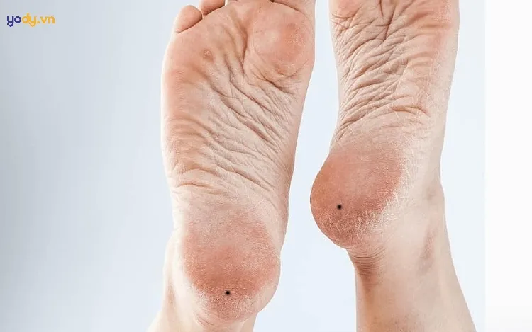 Ý nghĩa nốt ruồi ở gót chân trái nữ