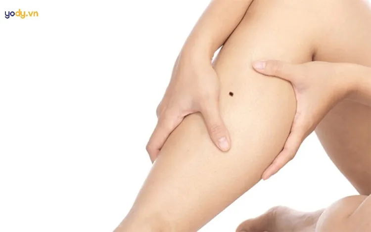 Nốt ruồi ở bắp chân trái và ý nghĩa